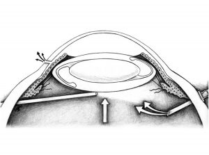 Kathy May's Medical Illustrations Published in a Retina Paper