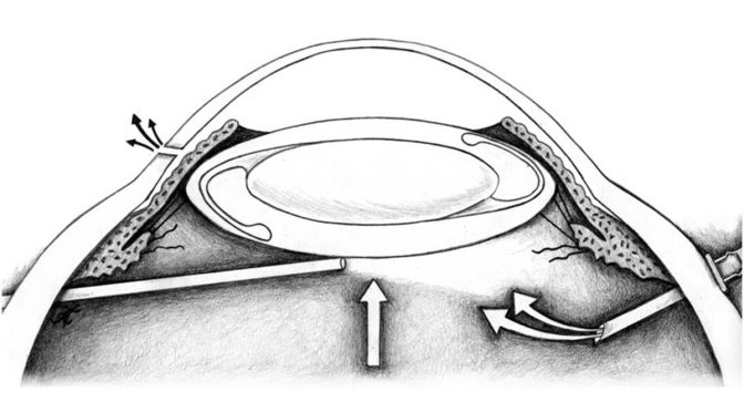 Kathy May’s Medical Illustrations Published in a Retina Paper